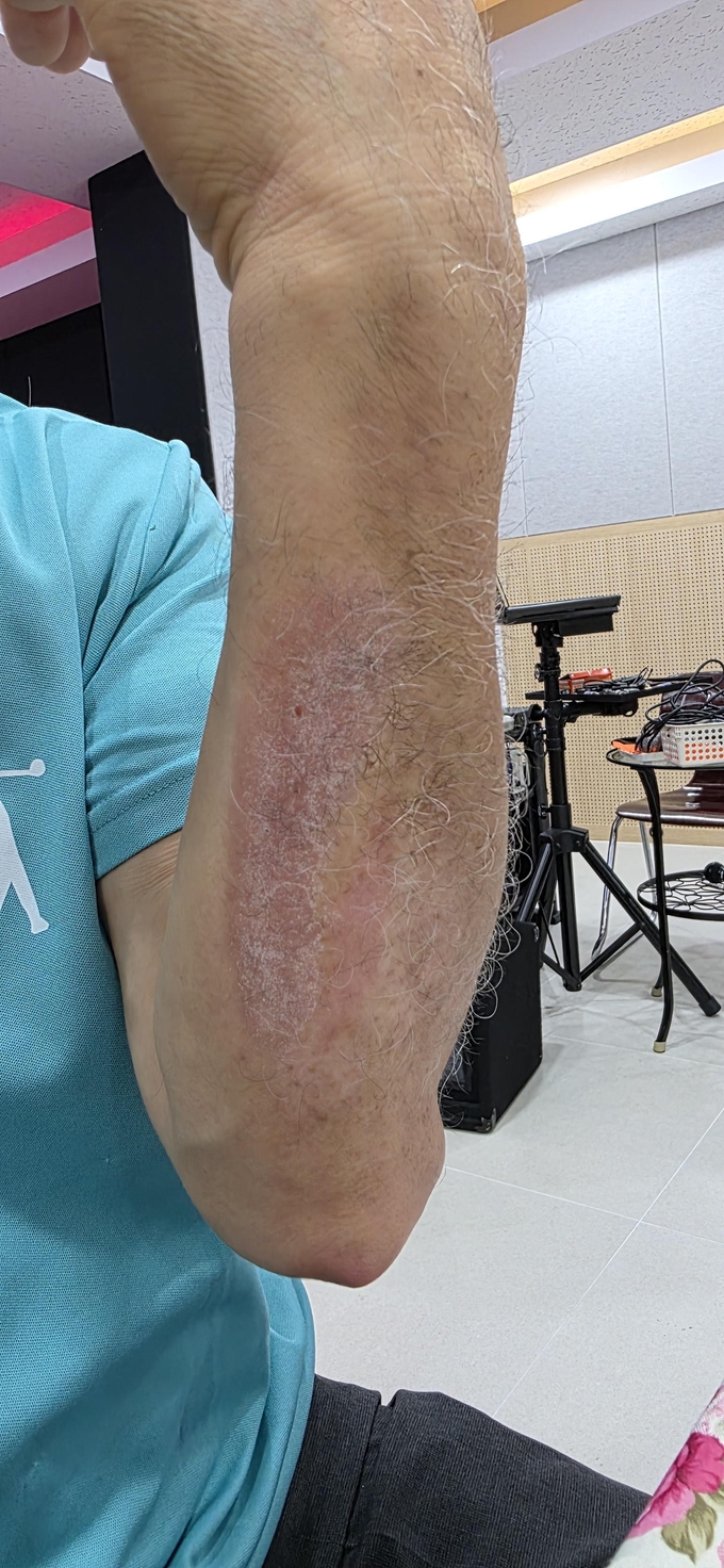 제과점에 종사하며 얻은 화상 상처
